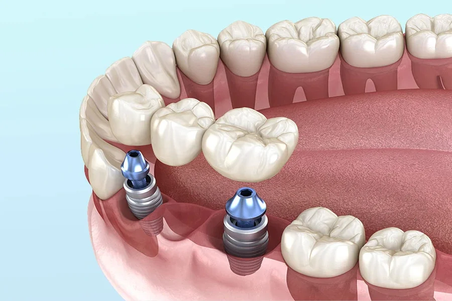 Supported Crowns